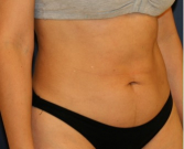 Feel Beautiful - Liposuction Flanks 215 - Before Photo